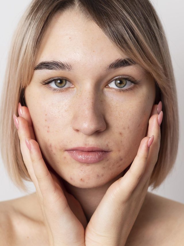 Here Are 8 Tips On How To Manage Melasma