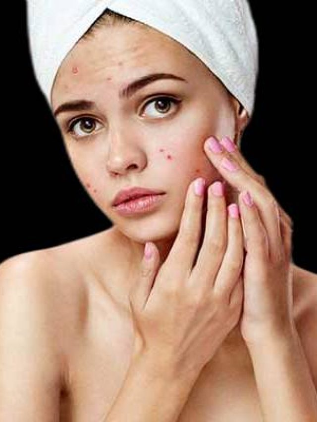 Here Are 8 Tips To Help Control Pimples On Your Face